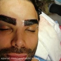 فیلم کاشت ابرو آقایان | کلینیک آیتک | 44228594-021