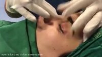 فیلم جراحی بینی حین عمل