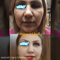 آموزش لیفت با نخ مجازی یا حضوری ایران زمین