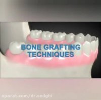 فیلم بازسازی استخوان فک برای انجام ایمپلنت