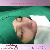 فیلم عمل بینی استخوانی