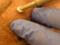 کرایو زگیل تناسلی