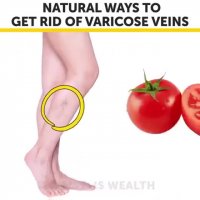 از بین رفتن واریس و کبودی