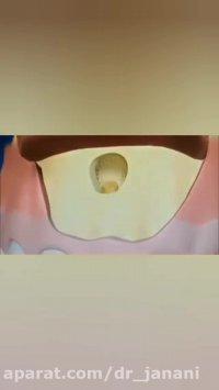 جراحی اپیکو