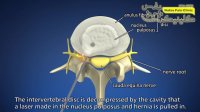 درمان دیسک کمر با لیزر