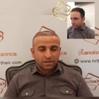 کاشت مو رنسانس- سوپر کاشت کلینیک تخصصی رنسانس