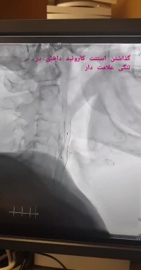 تنگی شدید شریان کاروتید داخلی