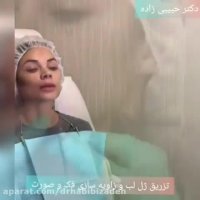 تزریق ژل لب و زاویه سازی فک و صورت