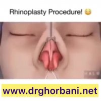 جراحی زیبایی بینی