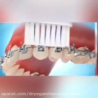 چگونه با وجود دستگاه ارتودنسی مسواک بزنیم؟
