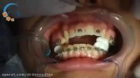 چسباندن براکت ارتودنسی | دکتر مسعود داوودیان