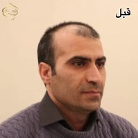 جدیدترین روش کاشت مو