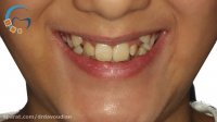 ارتودنسی بدون کشیدن دندان | دکتر مسعود داوودیان