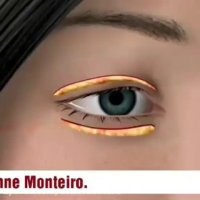 جراحی زیبایی پلک