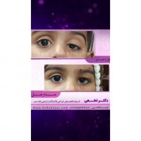 فیلم نمونه جراحی افتادگی یا پتوز پلک مادرزادی کودک 1 و نیم ساله