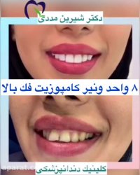 کامپوزیت فک بالا