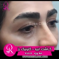 فیلم کاشت ابرو | کلینیک رز | 02148679 | شماره 2