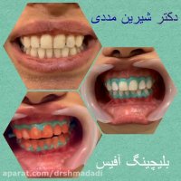 سفید شدن دندان ها