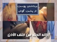 جراحه الاذن