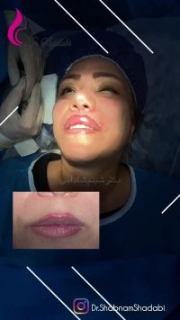 فیلم حجم دهی دائمی لب بلافاصله بعد از عمل