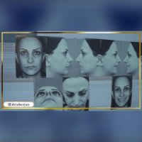 فیلم جراحی زیبایی سپتوپلاستی ثانویه