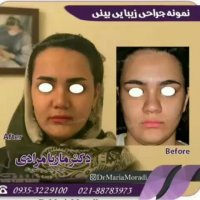 نمونه جراحی های زیبایی بینی در یک نگاه