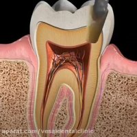 پوسیدگی دندان و ترمیم آن