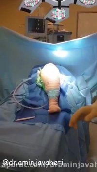 عمل جراحي تعويض مفصل زانو