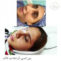 عمل ترمیم بینی
