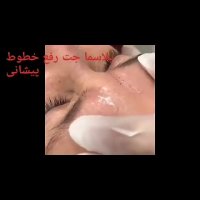 آموزش و انجام مزووایت میکرونیدلینگ پلاسما چال لپ