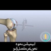 انیمیشن جراحی تعویض مفصل زانو
