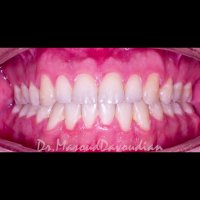 اصلاح انحراف فک پایین | دکتر داودیان