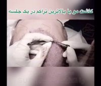 کلینیک تخصصی کاشت مو رنسانس