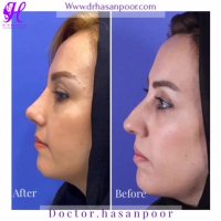 نمونه جراحی زیبایی بینی