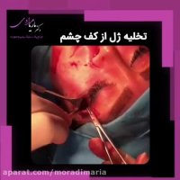 تخلیه ژل کف زیر چشم