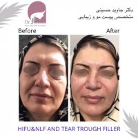 فیلم هایفوتراپی و تزریق ژل جوانسازی