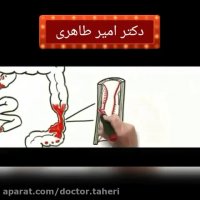 درمان بیماری التهابی روده | دکتر امیر طاهری