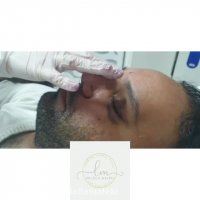 عمل بینی در مردان