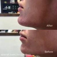 فرم دهی چانه