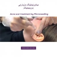 مزونیدلینگ