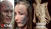 سندرم Stone Man چیست؟