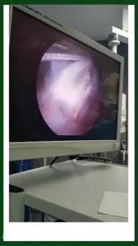 ترميم منيسك و بازسازى رباط صليبي