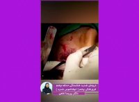 فیلم واقعی جراحی ترومای شدید شکستگی حدقه چشم