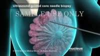 Breast Cancer | Breast Biopsy | Nucleus Health