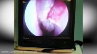 فیلم جراحی آندوسکپی سینوس و جراحی زیبایی بینی توسط دکتر امید ابراهیمی