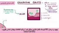 کولیت روده درمان تضمینی شد
