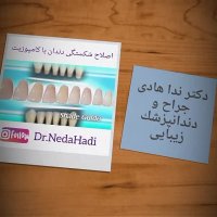 اصلاح شکستگی دندان با کامپوزیت