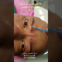 هاشور مویی ابرو برای بیمار مبتلا به آلوپسی