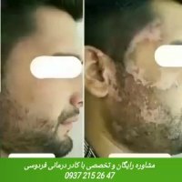 بیماری پوستی اگزما چیست؟؟ و درمان قطعی اگزما در طب سنتی