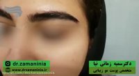 کاشت ابرو در دختران جوان